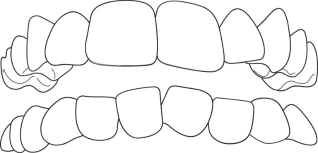 image example of crowded teeth